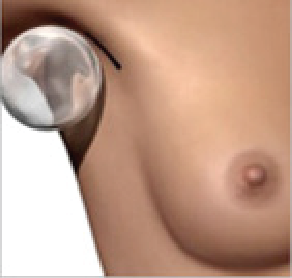 3. nacięcie w dole pachowym