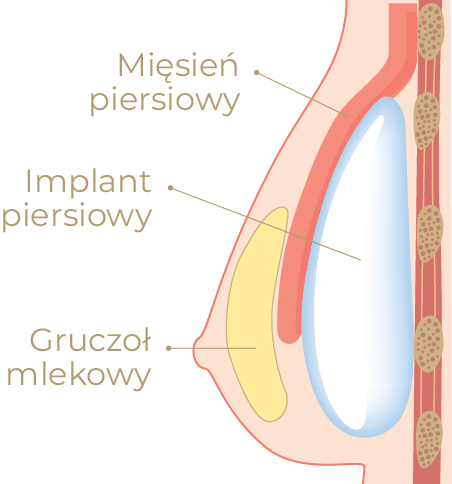 3. Technika dwupłaszczyznowa