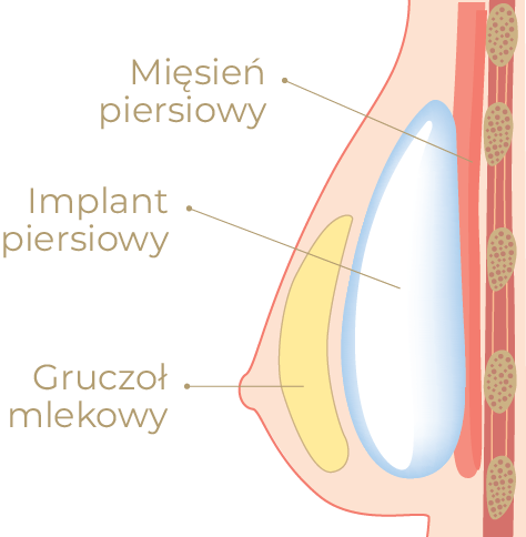 2. Umieszczenie pod gruczołem piersiowym